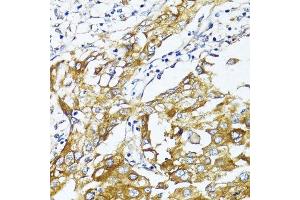 Immunohistochemistry of paraffin-embedded human liver cancer using SLC2A4 antibody.
