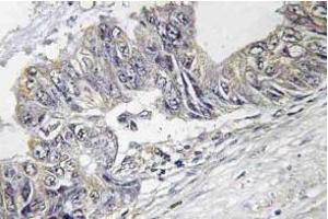 Immunohistochemistry (IHC) analyzes of p-JNK1/2/3 antibody in paraffin-embedded human colon carcinoma tissue. (JNK anticorps  (pThr183))