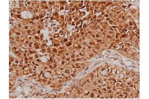ABIN6267363 at 1/200 staining Human lung cancer tissue sections by IHC-P. (MAPT anticorps  (pSer262))