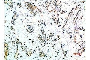 Immunohistochemical analysis of paraffin-embedded human-stomach-cancer, antibody was diluted at 1:200 (FCGR1A anticorps  (AA 230-280))