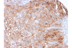 Formalin-fixed, paraffin-embedded human Urothelial Carcinoma stained with Uroplakin 1A Mouse Monoclonal Antibody (UPK1A/2925).