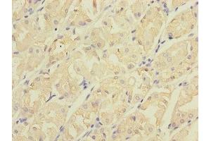 Immunohistochemistry of paraffin-embedded human gastric cancer using ABIN7147210 at dilution of 1:100 (CDC42EP2 anticorps  (AA 9-210))