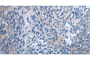 Immunohistochemistry of paraffin-embedded Human cervical cancer using IL2RB Polyclonal Antibody at dilution of 1:30 (IL2 Receptor beta anticorps)