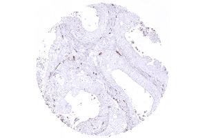 Adenocarcinoma of the colon with low content of CD163 positive macrophages