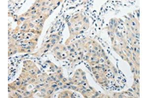 The image on the left is immunohistochemistry of paraffin-embedded Human lung cancer tissue using ABIN7189714(AGBL1 Antibody) at dilution 1/15, on the right is treated with synthetic peptide. (AGBL1 anticorps)