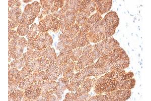 Formalin-fixed, paraffin-embedded human Basal Cell Carcinoma stained with EpCAM Rabbit Recombinant Monoclonal Antibody (EGP40/2041R). (Recombinant EpCAM anticorps  (Extracellular Domain))