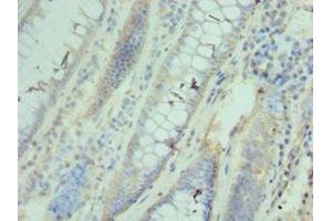 Immunohistochemistry of paraffin-embedded human colon cancer using ABIN7171427 at dilution of 1:100