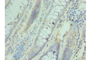 Immunohistochemistry of paraffin-embedded human colon cancer using ABIN7171427 at dilution of 1:100 (CCT3 anticorps  (AA 1-300))