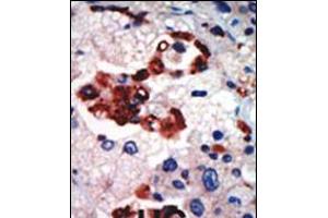 Formalin-fixed and paraffin-embedded human cancer tissue reacted with the primary antibody, which was peroxidase-conjugated to the secondary antibody, followed by AEC staining. (PKC iota anticorps  (N-Term))