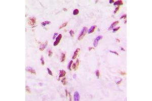 Immunohistochemical analysis of p53 (AcK319) staining in human lung cancer formalin fixed paraffin embedded tissue section. (p53 anticorps  (acLys319, C-Term))