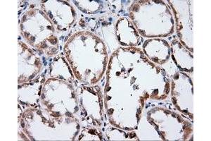 Immunohistochemical staining of paraffin-embedded Adenocarcinoma of ovary tissue using anti-ANXA1 mouse monoclonal antibody. (Annexin a1 anticorps)
