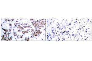 Immunohistochemical analysis of paraffin-embedded human breast carcinoma tissue, using MEF2A (phospho-Thr312) antibody (E011039). (MEF2A anticorps  (pThr312))