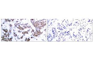 Immunohistochemical analysis of paraffin-embedded human breast carcinoma tissue, using MEF2A (phospho-Thr312) antibody (E011039). (MEF2A anticorps  (pThr312))