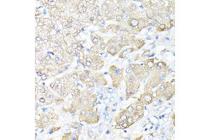 Immunohistochemistry of paraffin-embedded human liver cancer using Haptoglobin (Haptoglobin (HP)) antibody (ABIN3022157, ABIN3022158, ABIN1513029, ABIN1514188 and ABIN6218636) at dilution of 1:100 (40x lens). (Haptoglobin anticorps)