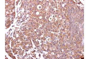 IHC-P Image Mucin 4 antibody detects Mucin 4 protein at cytosol on human breast carcinoma by immunohistochemical analysis. (MUC4 anticorps)