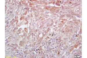 Formalin-fixed and paraffin embedded human lung carcinoma labeled with Rabbit Anti Trk A/B/C Polyclonal Antibody, Unconjugated (ABIN726095) at 1:200 followed by conjugation to the secondary antibody and DAB staining (TrkA, B, C (AA 668-750) anticorps)