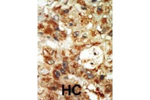 Formalin-fixed and paraffin-embedded human hepatocellular carcinoma tissue reacted with MAPK12 polyclonal antibody  , which was peroxidase-conjugated to the secondary antibody, followed by AEC staining. (MAPK12 anticorps  (Internal Region))