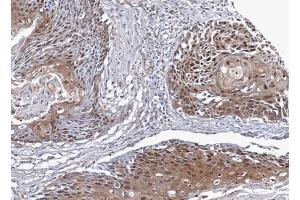 IHC-P Image Immunohistochemical analysis of paraffin-embedded differential N/T pair Lung SCC cancer xenograft, using NSFL1C, antibody at 1:100 dilution.