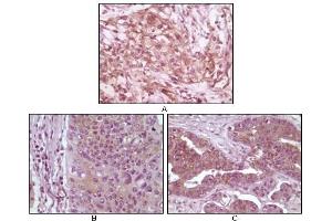 Immunohistochemical analysis of paraffin-embedded human pancreas carcinoma (A), esophagus carcinoma tissue (B) and ovary tumor tissue (C), showing cytoplasmic and membrane localization using 4E-BP1 antibody with DAB staining. (eIF4EBP1 anticorps)