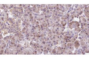ABIN6273233 at 1/100 staining Human pancreas cancer tissue by IHC-P. (DYNC2LI1 anticorps  (Internal Region))