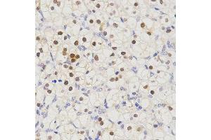 Immunohistochemistry of paraffin-embedded human kidney cancer tissue using SCTR antibody at dilution of 1:200 (x400 lens) (SCTR anticorps)