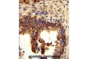 Formalin-fixed and paraffin-embedded human prostate carcinoma reacted with KRT4 Antibody (C-term), which was peroxidase-conjugated to the secondary antibody, followed by DAB staining.