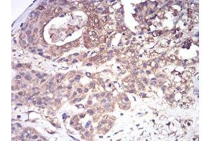 Immunohistochemical analysis of paraffin-embedded ovarian cancer tissues using CFHR5 mouse mAb with DAB staining.