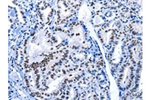 The image on the left is immunohistochemistry of paraffin-embedded Human thyroid cancer tissue using ABIN7191961(POU2AF1 Antibody) at dilution 1/15, on the right is treated with synthetic peptide. (POU2AF1 anticorps)