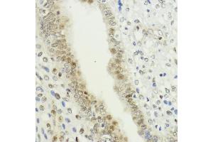 Immunohistochemistry of paraffin-embedded human uterine cancer using LDB1 antibody (ABIN7268255) at dilution of 1:200 (40x lens). (LIM Domain Binding 1 Protein anticorps  (AA 1-50))