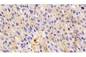 Detection of ORM2 in Human Liver cancer Tissue using Polyclonal Antibody to Orosomucoid 2 (ORM2) (Orosomucoid 2 anticorps)