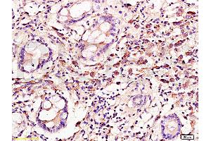 Formalin-fixed and paraffin embedded: human colon carcinoma labeled with Anti-Cyclin C Polyclonal Antibody, Unconjugated (ABIN727250) at 1:300, followed by conjugation to the secondary antibody and DAB staining (Cyclin C anticorps  (AA 23-100))