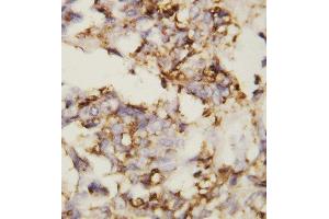 Anti-N Cadherin antibody, IHC(P) IHC(P): Human Ovary Cancer Tissue (N-Cadherin anticorps  (Middle Region))