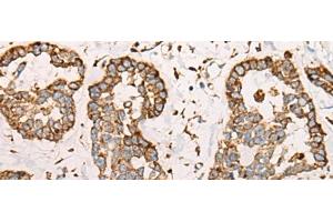 Immunohistochemistry of paraffin-embedded Human esophagus cancer tissue using CAPN9 Polyclonal Antibody at dilution of 1:45(x200) (Calpain 9 anticorps)