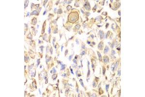 Immunohistochemistry of paraffin-embedded human lung cancer using CD151 antibody at dilution of 1:200 (400x lens). (CD151 anticorps)