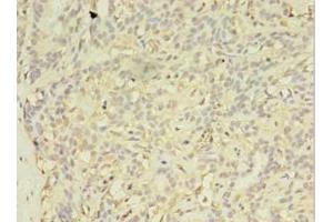 Immunohistochemistry of paraffin-embedded human breast cancer using ABIN7152293 at dilution of 1:100