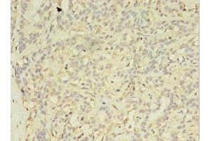 Immunohistochemistry of paraffin-embedded human breast cancer using ABIN7152293 at dilution of 1:100 (EXOSC5 anticorps  (AA 1-235))