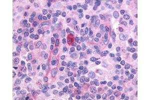 Anti-CD97 antibody IHC of human Lymph Node, Hodgkins Lymphoma. (CD97 anticorps  (N-Term))