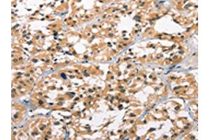 The image on the left is immunohistochemistry of paraffin-embedded Human thyroid cancer tissue using ABIN7190849(GPR182 Antibody) at dilution 1/30, on the right is treated with synthetic peptide.