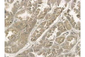 ABIN6258306 and ABIN6274290 at 1/100 staining human renal cell carcinoma by IHC-P. (PTTG1 anticorps  (C-Term))