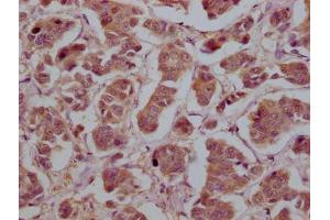 IHC image of ABIN7142109 diluted at 1:200 and staining in paraffin-embedded human breast cancer tissue performed on a Leica BondTM system.