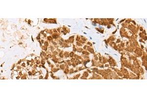 Immunohistochemistry of paraffin-embedded Human thyroid cancer tissue using ATN1 Polyclonal Antibody at dilution of 1:50(x200)