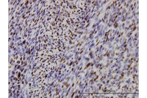 Immunoperoxidase of monoclonal antibody to IRF2 on formalin-fixed paraffin-embedded human leiomyosarcoma.