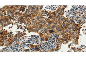 Immunohistochemistry of paraffin-embedded Human lung cancer using SERPINA9 Polyclonal Antibody at dilution of 1:60 (SERPINA9 anticorps)