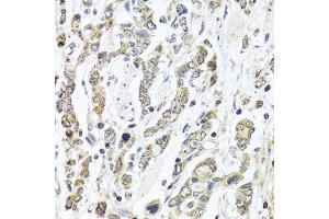 Immunohistochemistry of paraffin-embedded human gastric cancer using IFNL3 antibody (ABIN6293714) at dilution of 1:100 (40x lens). (IL28B anticorps)