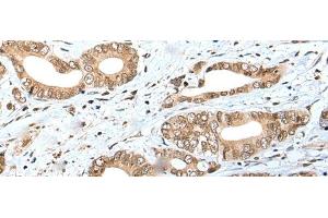 Immunohistochemistry of paraffin-embedded Human gastric cancer tissue using SPCS2 Polyclonal Antibody at dilution of 1:40(x200) (SPCS2 anticorps)
