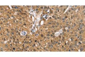 Immunohistochemistry of paraffin-embedded Human breast cancer using SORT1 Polyclonal Antibody at dilution of 1:35 (Sortilin 1 anticorps)