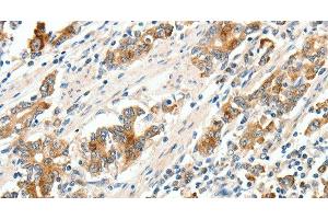 Immunohistochemistry of paraffin-embedded Human gastric cancer tissue using SCN9A Polyclonal Antibody at dilution 1:40