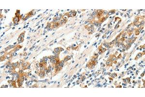 Immunohistochemistry of paraffin-embedded Human gastric cancer tissue using SCN9A Polyclonal Antibody at dilution 1:40 (SCN9A anticorps)