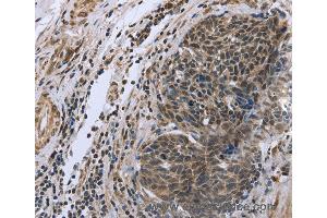 Immunohistochemistry of Human ovarian cancer using FANCG Polyclonal Antibody at dilution of 1:50 (FANCG anticorps)