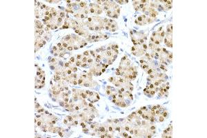 Immunohistochemistry of paraffin-embedded human liver cancer using HNF-4-alpha Rabbit mAb (ABIN7267621) at dilution of 1:150 (40x lens). (HNF4A anticorps)